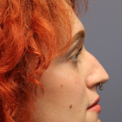 Rhinoplasty Before & After Patient #5053