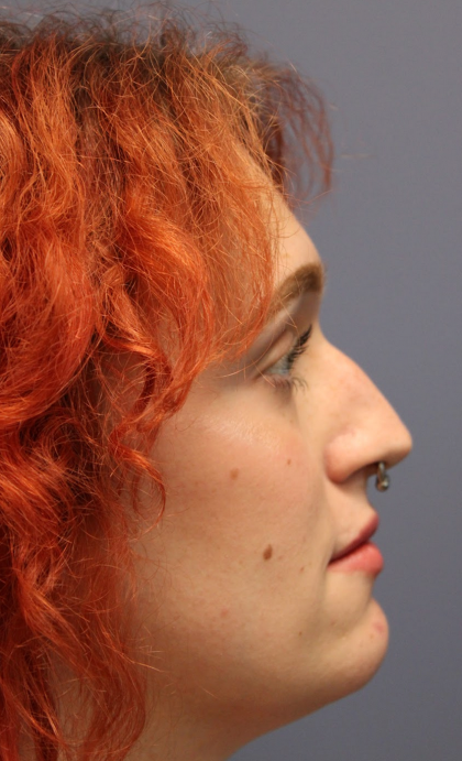 Rhinoplasty Before & After Patient #5053