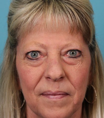 Upper Blepharoplasty Before & After Patient #5052