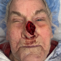 Mohs Surgery Before & After Patient #5055
