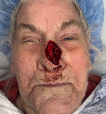 Mohs Surgery Before & After Patient #5055