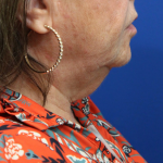 Anterior Neck Lift Before & After Patient #5027
