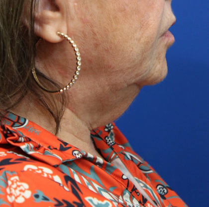 Anterior Neck Lift Before & After Patient #5027