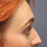 Facial Feminization Before & After Patient #5031