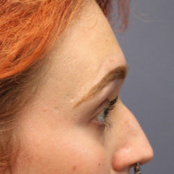 Facial Feminization Before & After Patient #5031