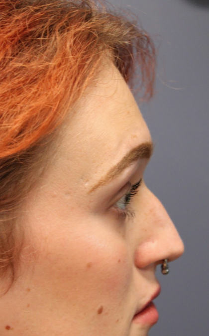 Facial Feminization Before & After Patient #5031