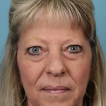 Lower Blepharoplasty Before & After Patient #5030