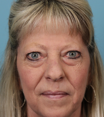 Lower Blepharoplasty Before & After Patient #5030