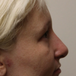 Revision Rhinoplasty Before & After Patient #5028