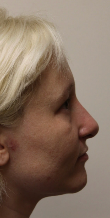 Revision Rhinoplasty Before & After Patient #5028