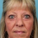 Upper Blepharoplasty Before & After Patient #5052