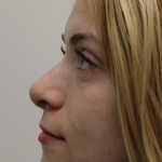 Revision Rhinoplasty Before & After Patient #5029