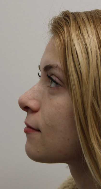 Revision Rhinoplasty Before & After Patient #5029