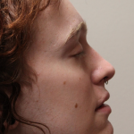 Rhinoplasty Before & After Patient #5053