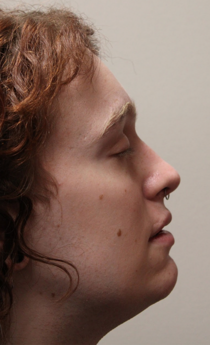 Rhinoplasty Before & After Patient #5053