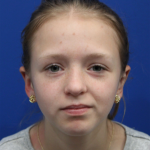 Otoplasty Before & After Patient #5054