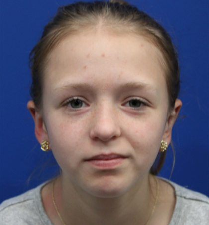 Otoplasty Before & After Patient #5054