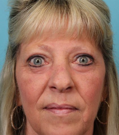 Upper Blepharoplasty Before & After Patient #5052