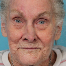 Mohs Surgery Before & After Patient #5055