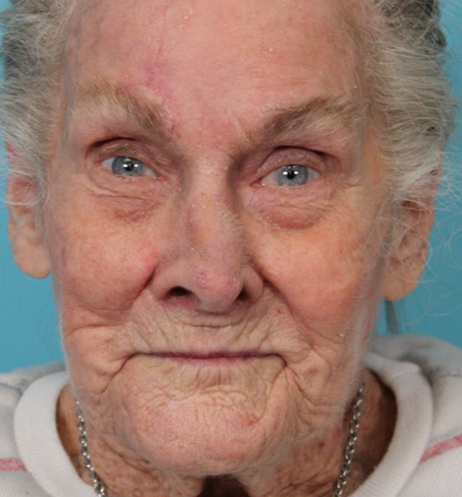 Mohs Surgery Before & After Patient #5055