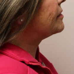 Anterior Neck Lift Before & After Patient #5027