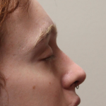 Facial Feminization Before & After Patient #5031