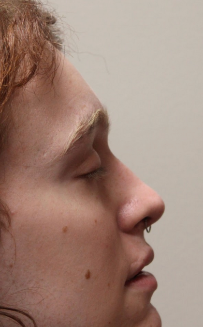 Facial Feminization Before & After Patient #5031