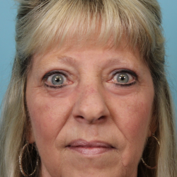 Lower Blepharoplasty Before & After Patient #5030