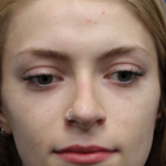 Revision Rhinoplasty Before & After Patient #5029