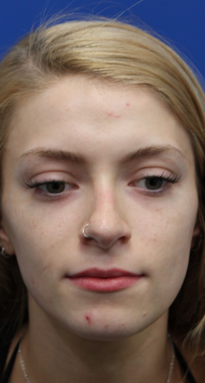 Revision Rhinoplasty Before & After Patient #5029