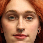 Rhinoplasty Before & After Patient #5053