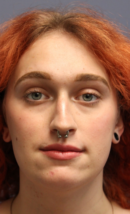 Rhinoplasty Before & After Patient #5053