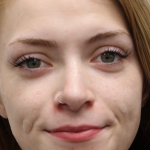 Revision Rhinoplasty Before & After Patient #5029