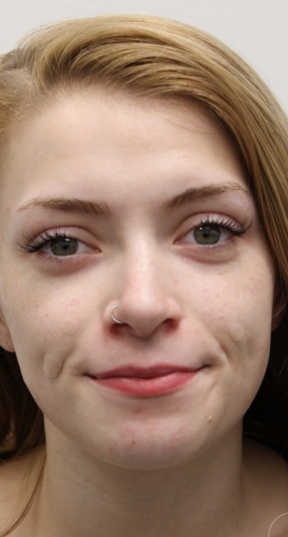 Revision Rhinoplasty Before & After Patient #5029
