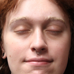 Rhinoplasty Before & After Patient #5053