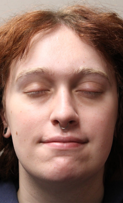 Rhinoplasty Before & After Patient #5053