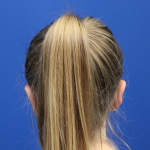 Otoplasty Before & After Patient #5054