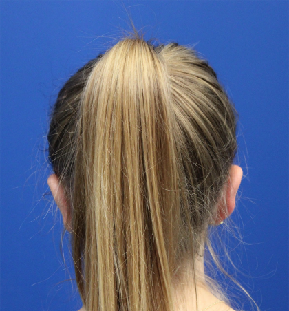 Otoplasty Before & After Patient #5054