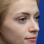 Revision Rhinoplasty Before & After Patient #5029