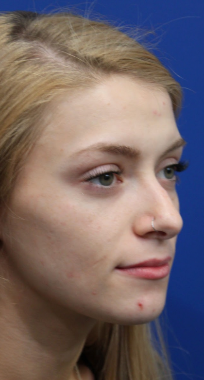 Revision Rhinoplasty Before & After Patient #5029