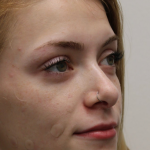 Revision Rhinoplasty Before & After Patient #5029