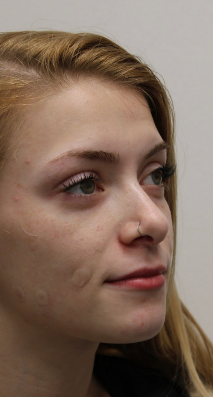 Revision Rhinoplasty Before & After Patient #5029