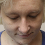 Revision Rhinoplasty Before & After Patient #5028