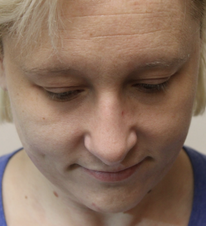 Revision Rhinoplasty Before & After Patient #5028
