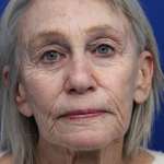 Laser Resurfacing Before & After Patient #5091