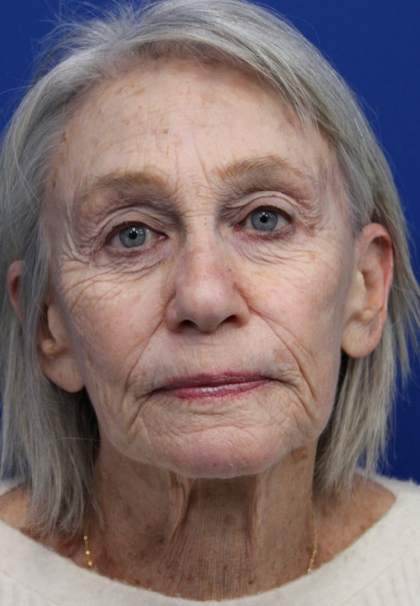 Laser Resurfacing Before & After Patient #5091