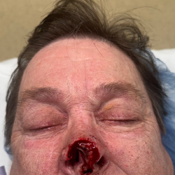 Mohs Surgery Before & After Patient #5069