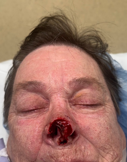 Mohs Surgery Before & After Patient #5069