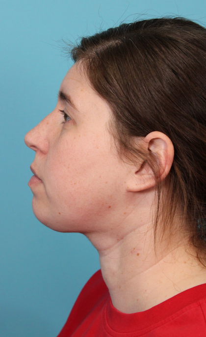 Submental Liposuction Before & After Patient #5074