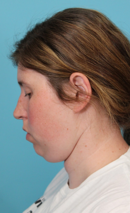 Submental Liposuction Before & After Patient #5074